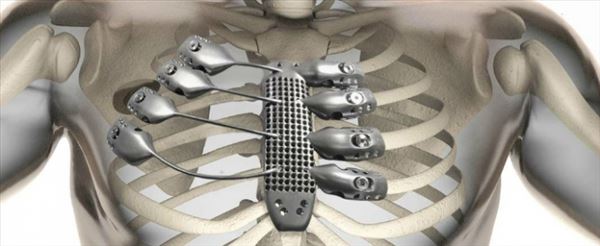 Kanser Hastasına 3D Yazıcı İle Üretilen Göğüs Kemiği ve Kaburgalar Yerleştirildi